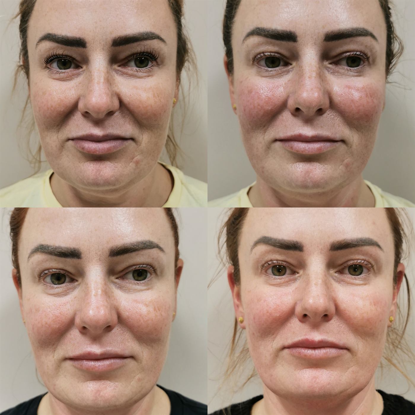 Vivena Massage before and after — neck and jawline lift result, Corby