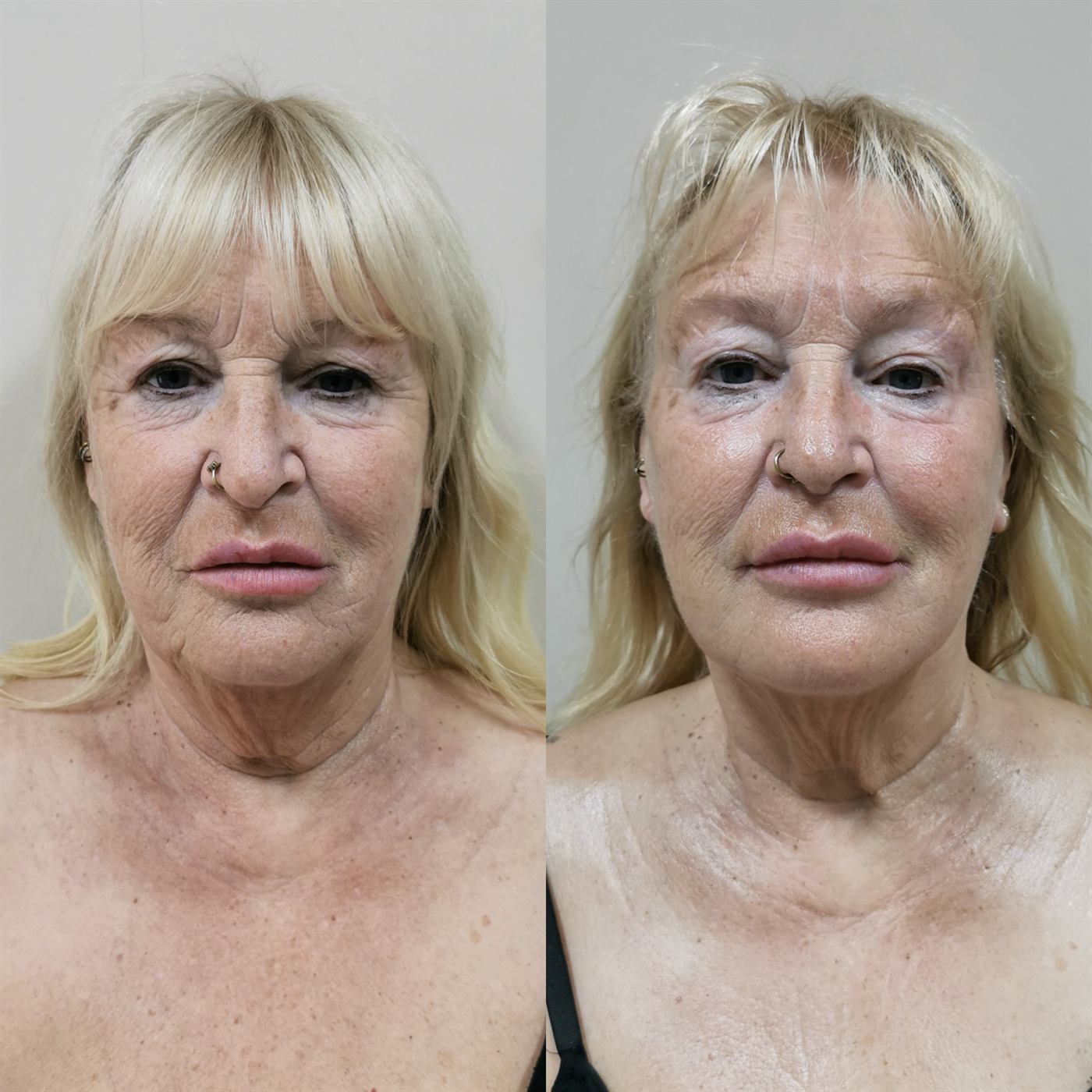 Vivena Massage before and after — full face rejuvenation, Village Beauty Corby